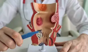 Model anatomiczny przedstawia hemoroidy wewnętrzne. Lekarz pokazuje narzędziem obszar objęty chorobą, co symbolizuje leczenie.