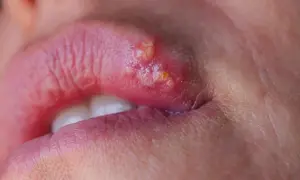 Opryszczka na ustach. Szukasz sposobu na opryszczkę w 1 dzień? Zobacz, jak szybko pozbyć się tej uciążliwej zmiany.