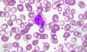 Monocyty w obrazie mikroskopowym. Kiedy martwić się o ich liczbę? Oto obraz, który może pomóc w diagnostyce.