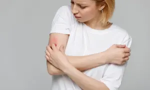 Kobieta z zaczerwienionym, swędzącym ramieniem, szuka ulgi. Czy wapno na alergie pomoże?