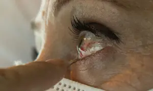 Widoczne pęknięte naczynko w oku. Palec delikatnie dotyka powieki, sugerując poszukiwanie domowe sposoby na jego zniknięcie.
