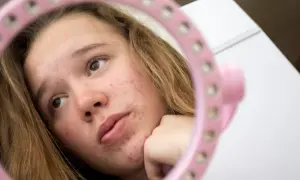 Dziewczyna zmagająca się z trądzikiem u nastolatka spogląda w różowe lusterko, analizując swoją skórę.