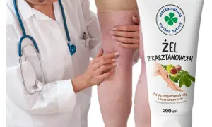 Lekarz bada nogę z widocznymi żylakami. Obok tubka żelu z kasztanowcem na zmęczone nogi.