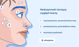 Nadczynność tarczycy: wytrzeszczone oczy, przetłuszczone włosy i wzmożona potliwość to objawy, które mogą świadczyć o problemach z tarczycą.