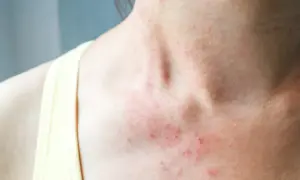 Skóra na szyi i dekolcie z zaczerwienieniem i wysypką. Może to być objaw alergii lub podrażnienia, na które czasem stosuje się nadmanganian potasu na co dzień.