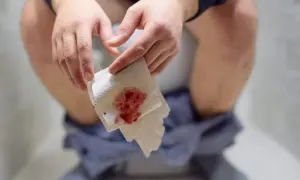 Dłoń trzymająca papier toaletowy z widocznymi śladami krwawienia z odbytu po oddaniu stolca.