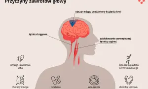Ilustracja pokazuje przyczyny zawrotów głowy: problemy z tętnicami, mózgiem, uchem, leki, metabolizm, układ przedsionkowy i serce.