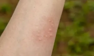 Ręka z zaczerwienionymi bąblami, objawami pokrzywki. Zastanawiasz się, co na pokrzywkę?