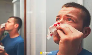 Mężczyzna z krwawiącym nosem przykłada chusteczkę. Widzi siebie w lustrze, szukając sposobu, jak zatamować krwotok z nosa.
