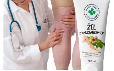 Lekarz bada nogę z widocznymi żylakami. Obok tubka żelu z kasztanowcem na zmęczone nogi.