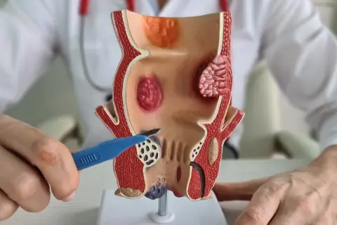 Model anatomiczny przedstawia hemoroidy wewnętrzne. Lekarz pokazuje narzędziem obszar objęty chorobą, co symbolizuje leczenie.