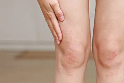 Dłonie dotykają kolana z zaczerwienieniem i wysypką, które mogą być objawami wysokiego cholesterolu.