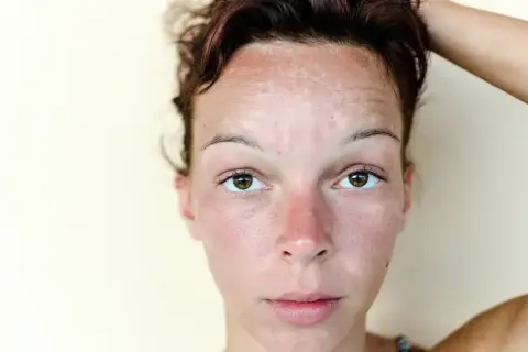 Skóra czoła kobiety pokryta jest białymi plamami, które mogą być wynikiem oparzenia słonecznego lub problemów dermatologicznych.