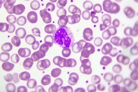 Monocyty w obrazie mikroskopowym. Kiedy martwić się o ich liczbę? Oto obraz, który może pomóc w diagnostyce.
