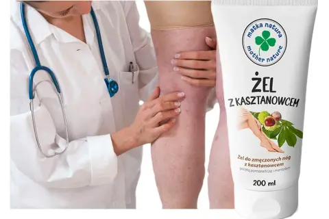 Lekarz bada nogę z widocznymi żylakami. Obok tubka żelu z kasztanowcem na zmęczone nogi.