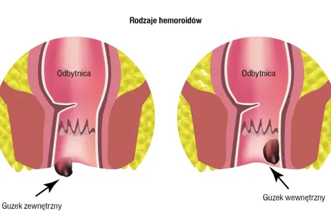 Ilustracja pokazuje zewnętrzne i wewnętrzne guzki krwawnicze. Czy hemoroidy są groźne? Zależy od ich stadium.