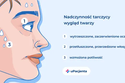 Nadczynność tarczycy: wytrzeszczone oczy, przetłuszczone włosy i wzmożona potliwość to objawy, które mogą świadczyć o problemach z tarczycą.