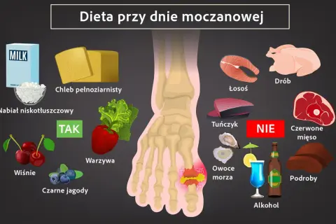Dieta przy dnie moczanowej: nabiał, chleb, warzywa, owoce (wiśnie, jagody) - TAK. Ryby, drób, alkohol, podroby, czerwone mięso - NIE. Pomaga obniżyć podwyższony kwas moczowy.