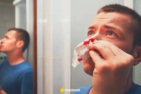 Mężczyzna z krwawiącym nosem przykłada chusteczkę. Widzi siebie w lustrze, szukając sposobu, jak zatamować krwotok z nosa.