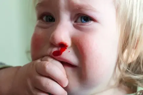 Małe dziecko z krwawiącym nosem. Krwawienie z nosa z jednej dziurki może mieć różne przyczyny, np. uraz lub suchość.