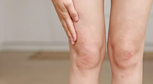 Dłonie dotykają kolana z zaczerwienieniem i wysypką, które mogą być objawami wysokiego cholesterolu.