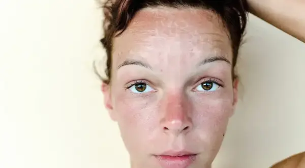 Skóra czoła kobiety pokryta jest białymi plamami, które mogą być wynikiem oparzenia słonecznego lub problemów dermatologicznych.