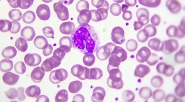 Monocyty w obrazie mikroskopowym. Kiedy martwić się o ich liczbę? Oto obraz, który może pomóc w diagnostyce.