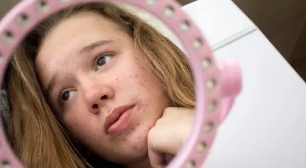 Dziewczyna zmagająca się z trądzikiem u nastolatka spogląda w różowe lusterko, analizując swoją skórę.