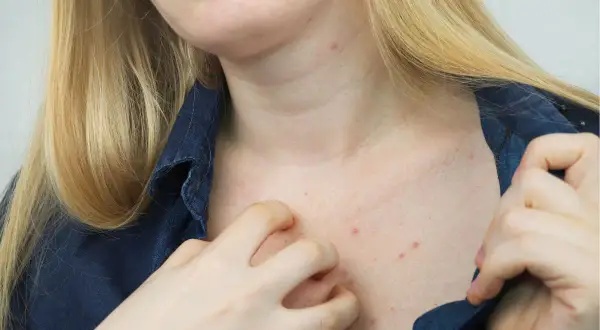 Skóra na klatce piersiowej i szyi z czerwonymi krostkami i zadrapaniami, pokazująca, jak wygląda świerzb.