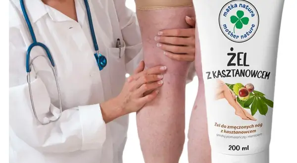 Lekarz bada nogę z widocznymi żylakami. Obok tubka żelu z kasztanowcem na zmęczone nogi.