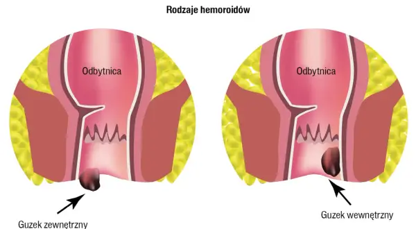 Ilustracja pokazuje zewnętrzne i wewnętrzne guzki krwawnicze. Czy hemoroidy są groźne? Zależy od ich stadium.