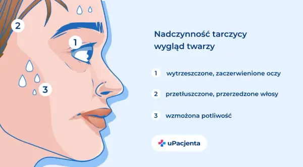 Nadczynność tarczycy: wytrzeszczone oczy, przetłuszczone włosy i wzmożona potliwość to objawy, które mogą świadczyć o problemach z tarczycą.