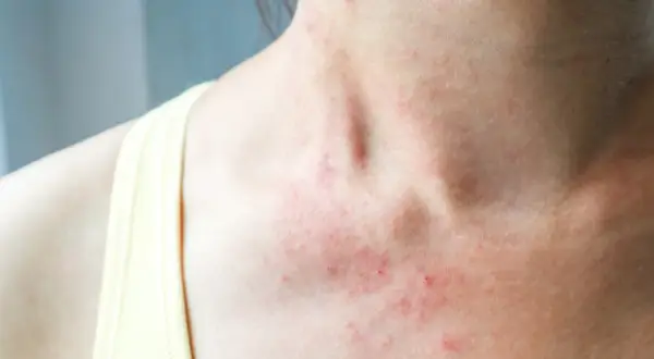 Skóra na szyi i dekolcie z zaczerwienieniem i wysypką. Może to być objaw alergii lub podrażnienia, na które czasem stosuje się nadmanganian potasu na co dzień.