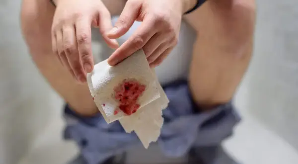Dłoń trzymająca papier toaletowy z widocznymi śladami krwawienia z odbytu po oddaniu stolca.