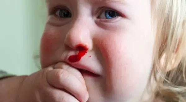 Małe dziecko z krwawiącym nosem. Krwawienie z nosa z jednej dziurki może mieć różne przyczyny, np. uraz lub suchość.