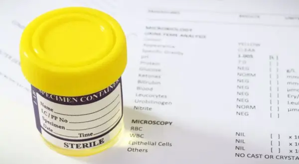 Żółty pojemnik na mocz i wyniki badania laboratoryjnego. Badanie to może pomóc ocenić gfr co to za badanie.