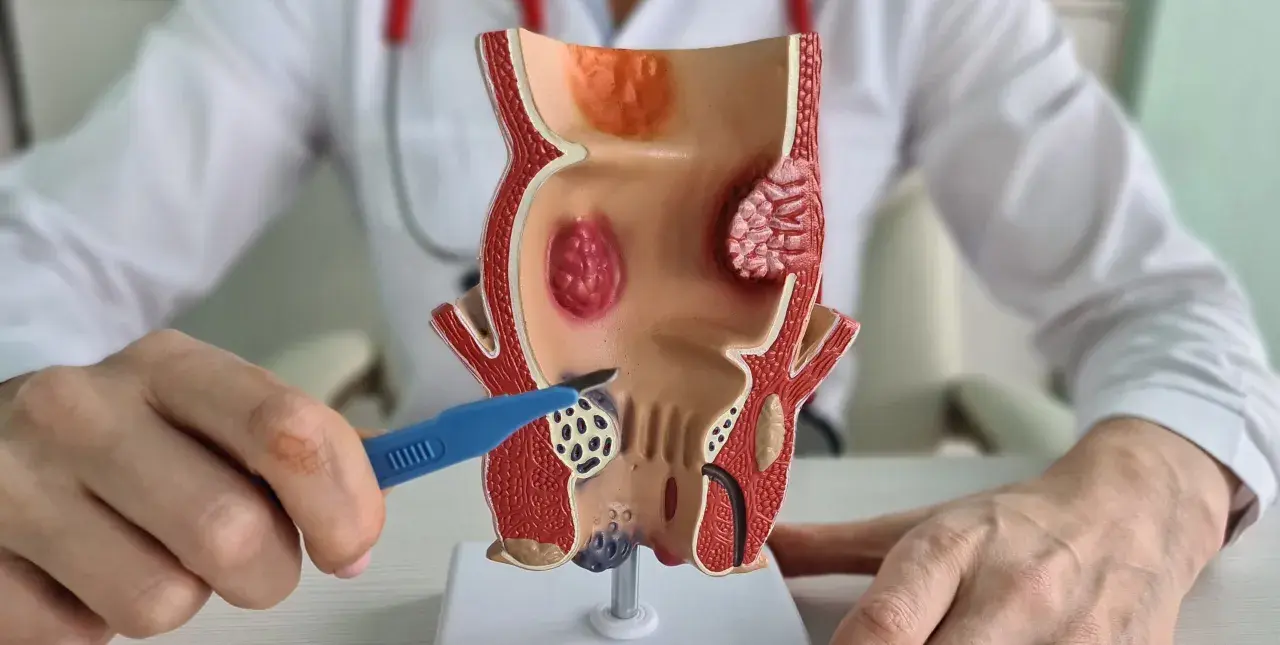 Model anatomiczny przedstawia hemoroidy wewnętrzne. Lekarz pokazuje narzędziem obszar objęty chorobą, co symbolizuje leczenie.