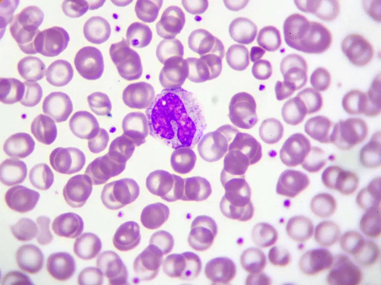 Monocyty w obrazie mikroskopowym. Kiedy martwić się o ich liczbę? Oto obraz, który może pomóc w diagnostyce.