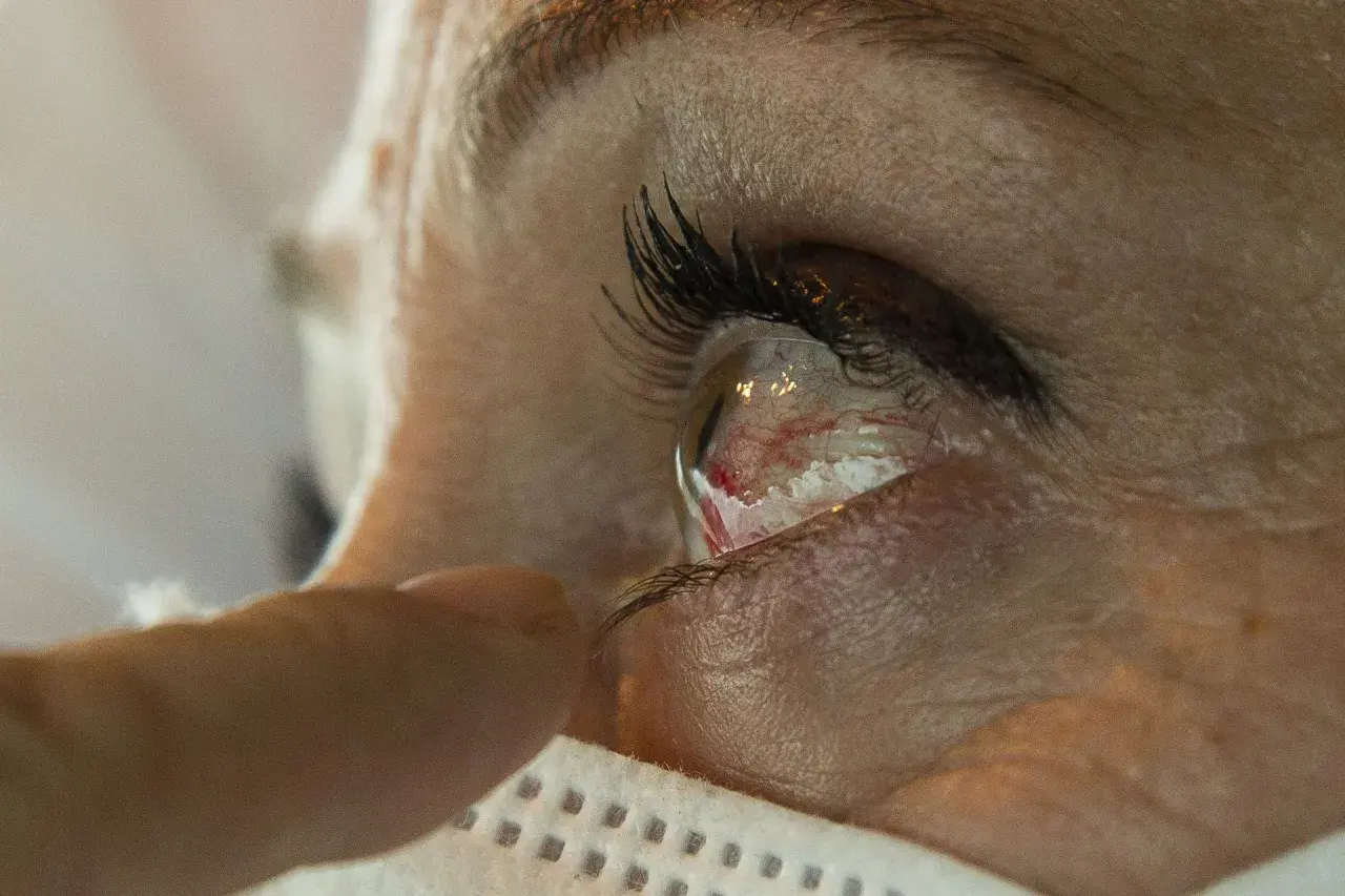 Widoczne pęknięte naczynko w oku. Palec delikatnie dotyka powieki, sugerując poszukiwanie domowe sposoby na jego zniknięcie.