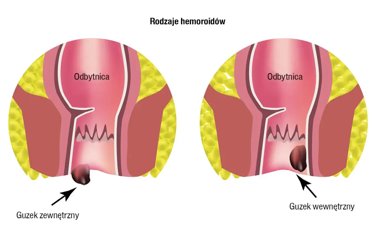 Ilustracja pokazuje zewnętrzne i wewnętrzne guzki krwawnicze. Czy hemoroidy są groźne? Zależy od ich stadium.