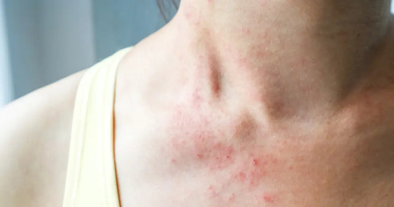 Skóra na szyi i dekolcie z zaczerwienieniem i wysypką. Może to być objaw alergii lub podrażnienia, na które czasem stosuje się nadmanganian potasu na co dzień.