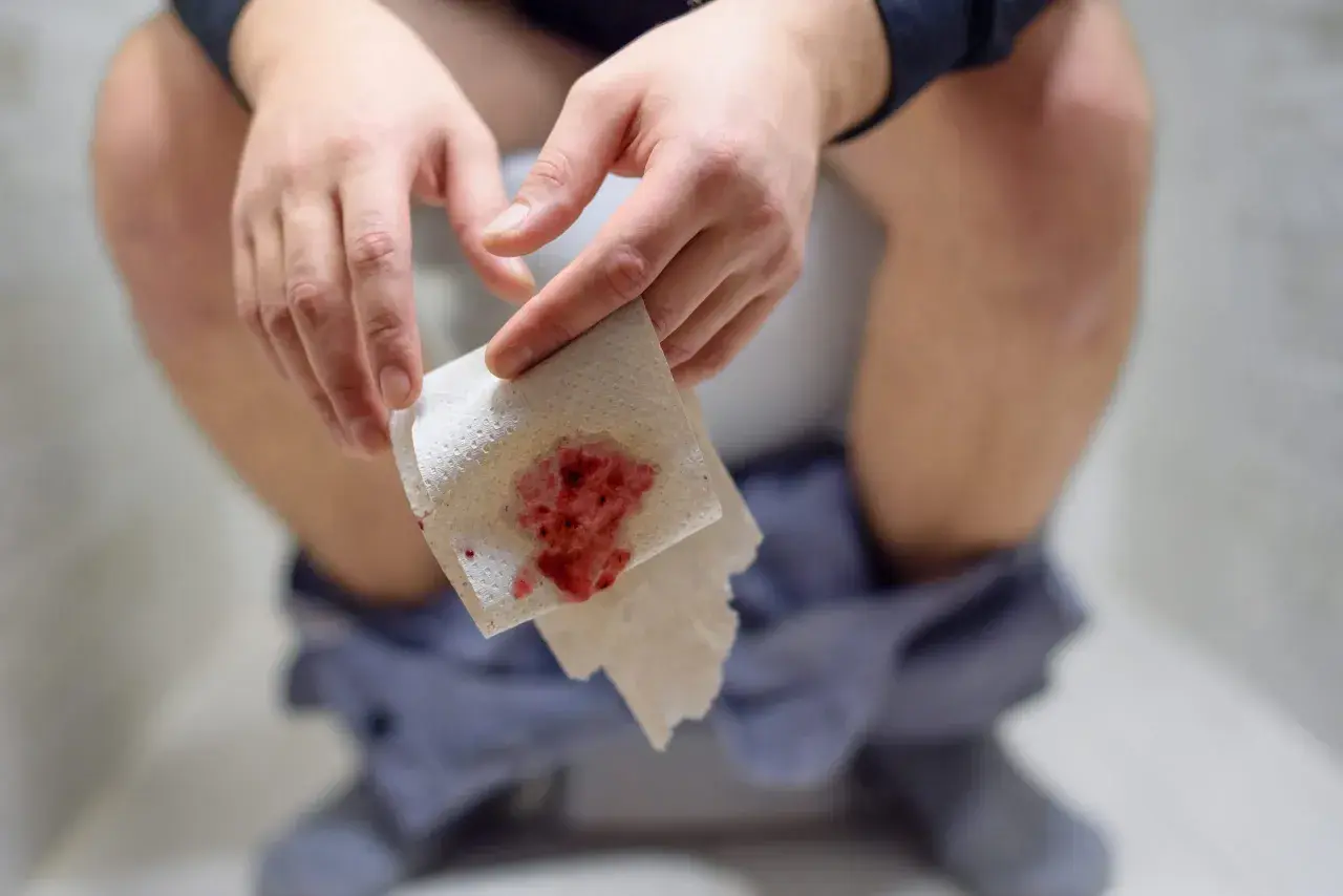 Dłoń trzymająca papier toaletowy z widocznymi śladami krwawienia z odbytu po oddaniu stolca.