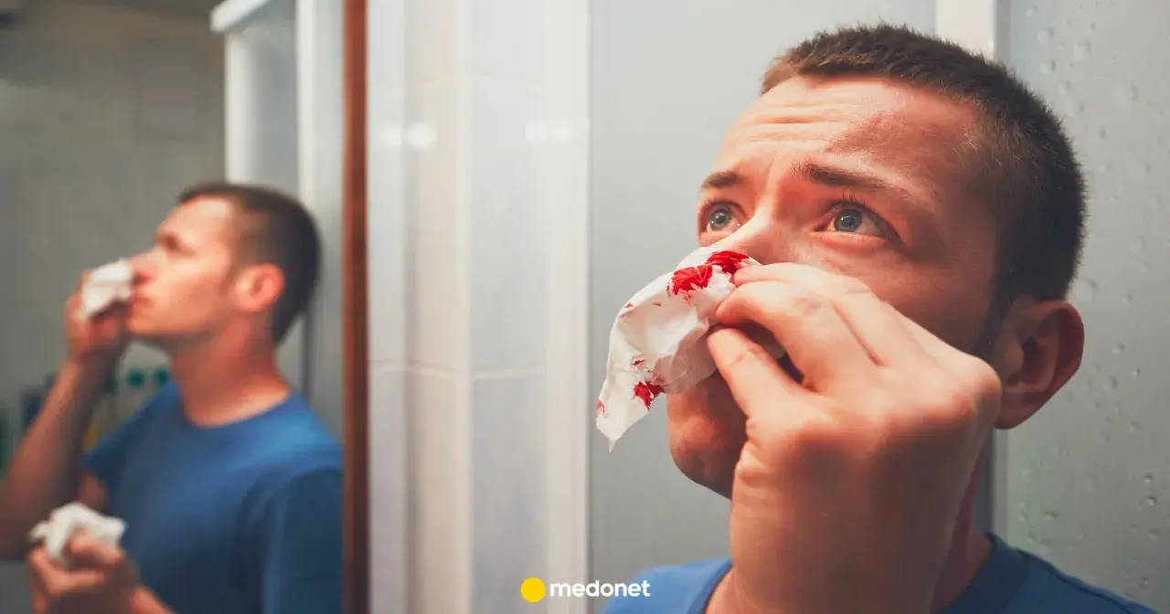 Mężczyzna z krwawiącym nosem przykłada chusteczkę. Widzi siebie w lustrze, szukając sposobu, jak zatamować krwotok z nosa.