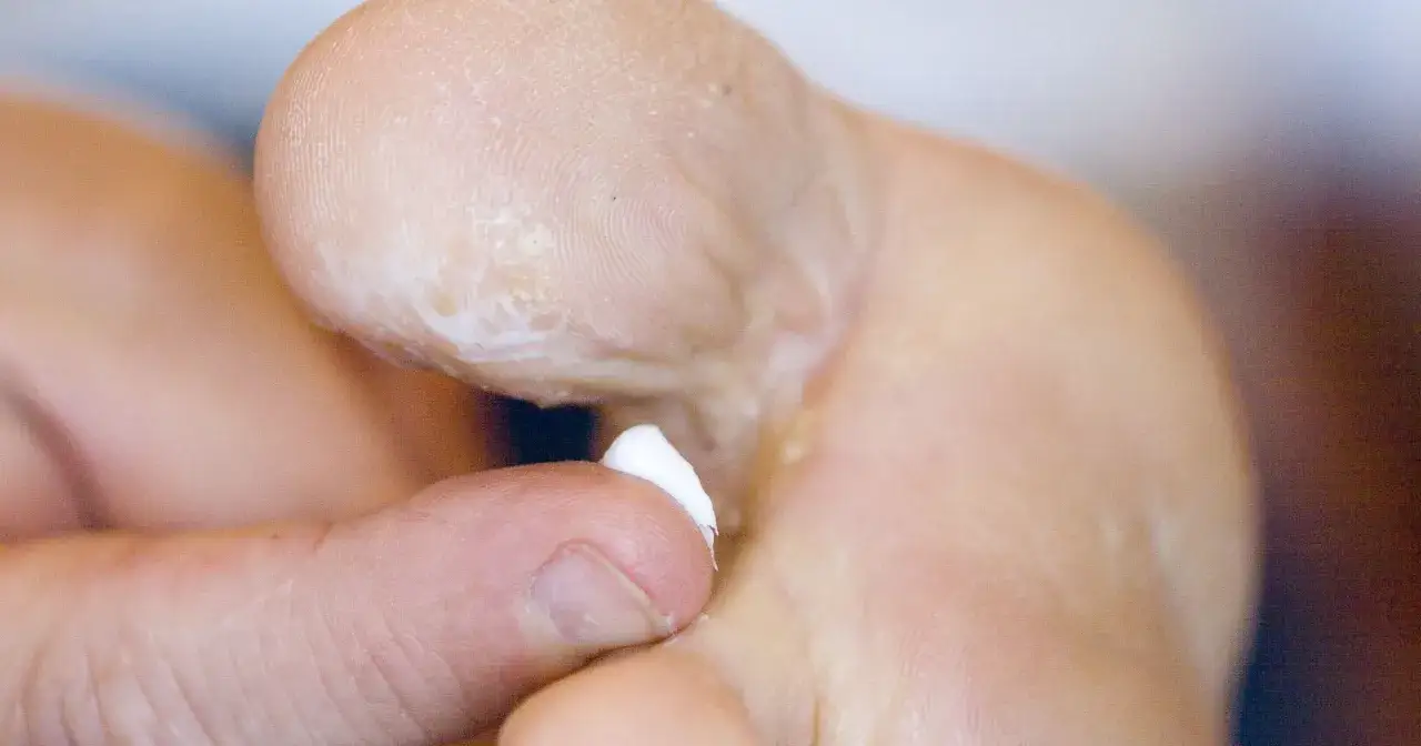 Dłoń aplikuje krem Sudocrem na palce stóp, by złagodzić objawy grzybicy.