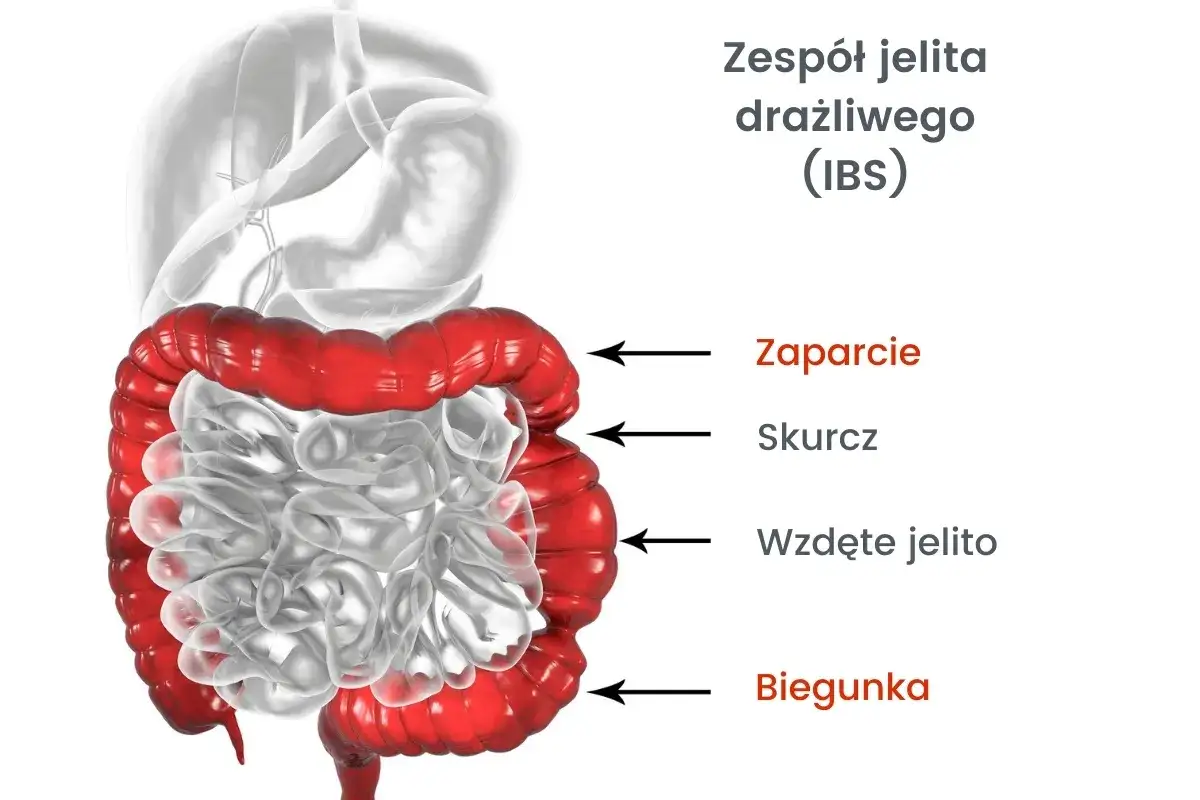 Grafika przedstawia jelito grube w czerwonym kolorze, symbolizujące atak jelita drażliwego (IBS) z objawami: zaparcie, skurcz, wzdęcie i biegunka.