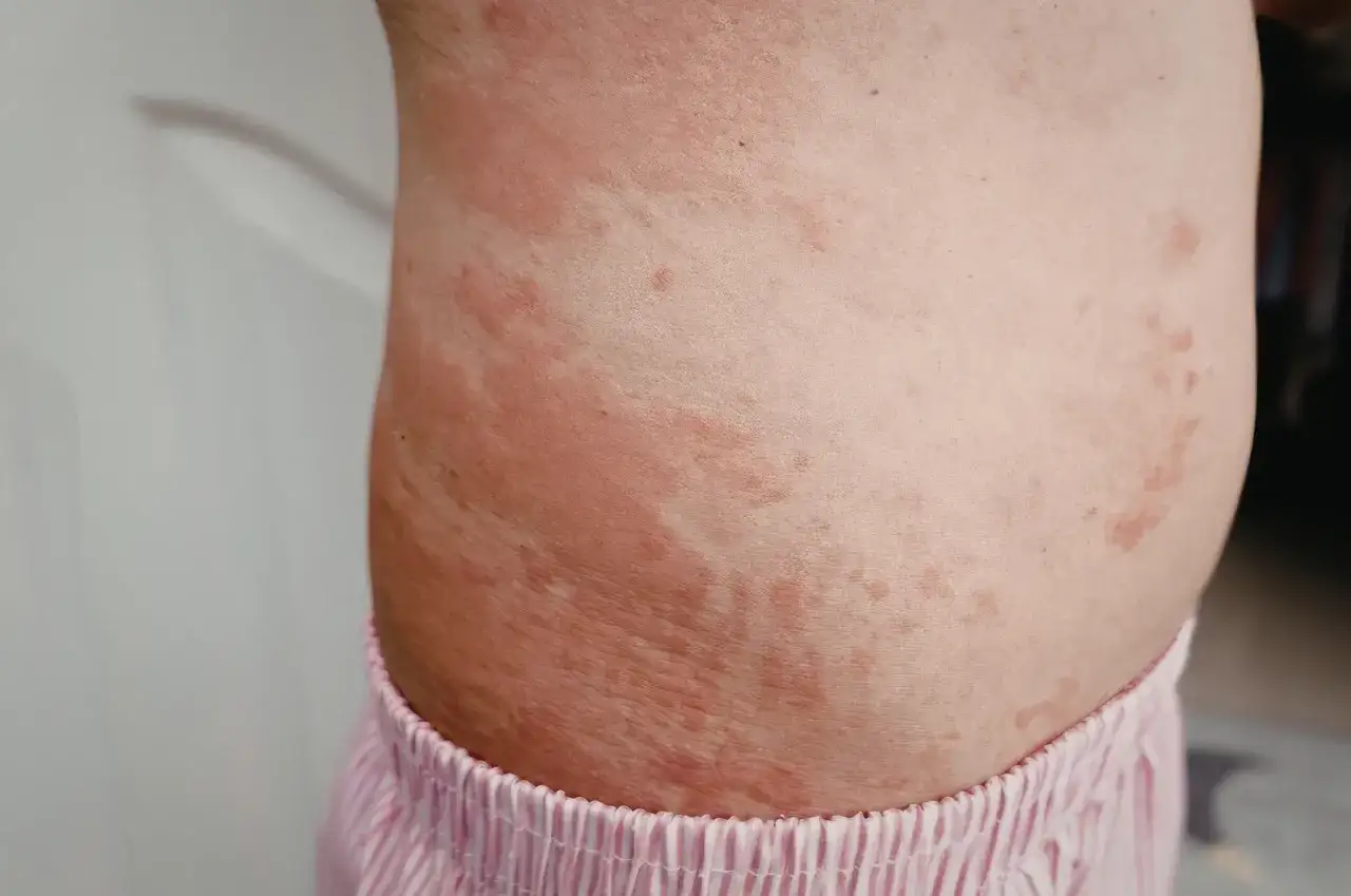 Widoczne suche plamy na ciele, zaczerwienienia i nierówności skóry, sugerujące problem dermatologiczny.