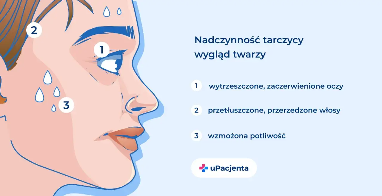 Objawy nadczynności tarczycy: wytrzeszczone oczy, przetłuszczone włosy i wzmożona potliwość.