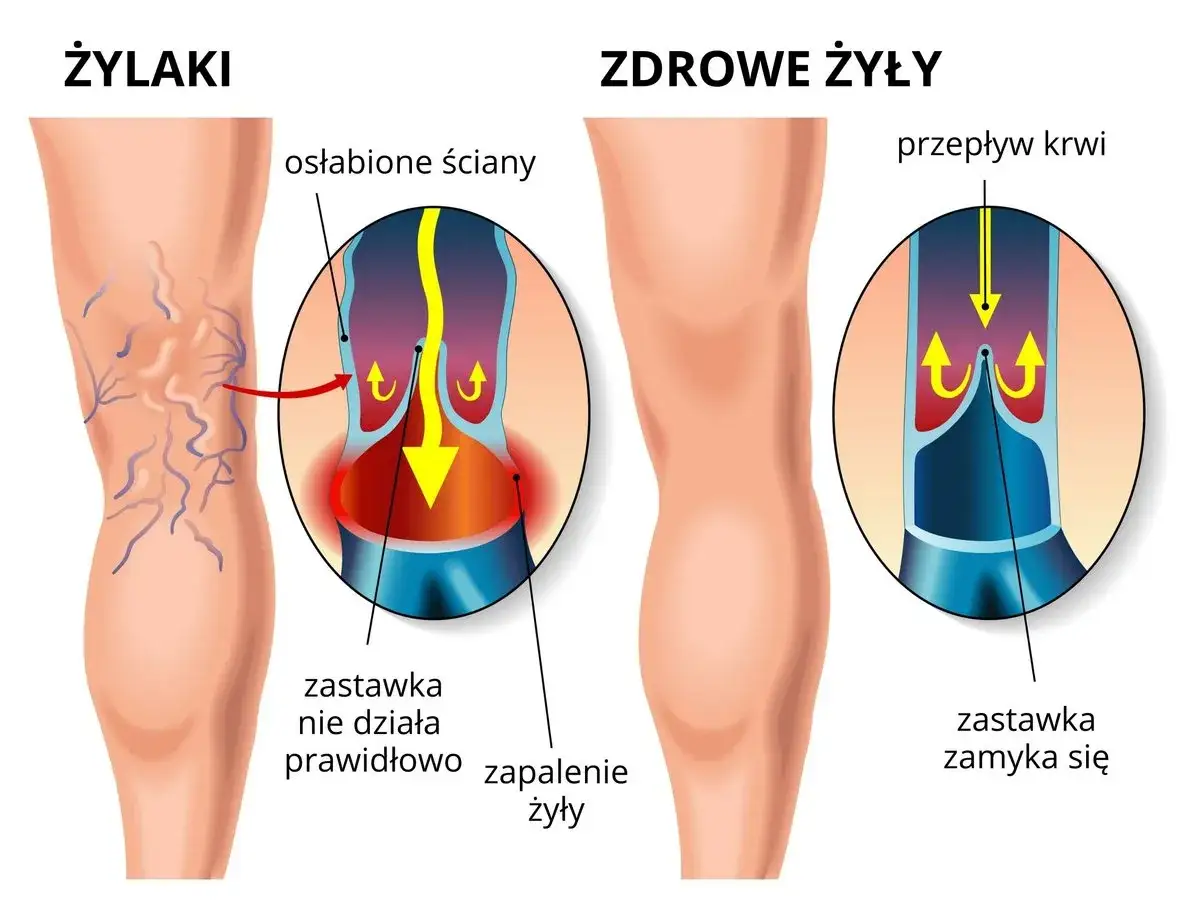 Ilustracja pokazuje żylaki na nodze, gdzie osłabione ściany żył i wadliwe zastawki powodują zapalenie. Zdrowe żyły mają prawidłowy przepływ krwi.