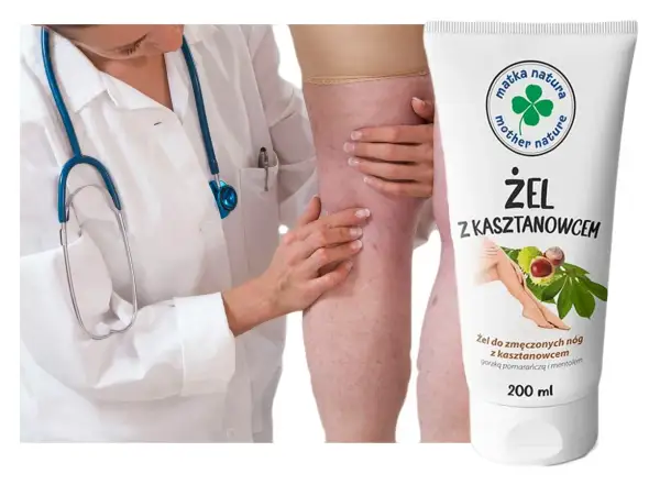 Lekarz bada nogę z widocznymi żylakami. Obok tubka żelu z kasztanowcem na zmęczone nogi.