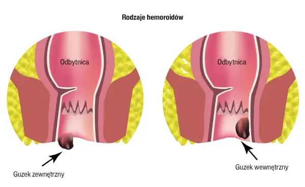 Ilustracja pokazuje zewnętrzne i wewnętrzne guzki krwawnicze. Czy hemoroidy są groźne? Zależy od ich stadium.